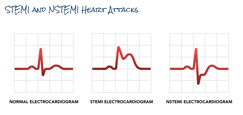 Non-ST Elevation Myocardial Infarction Heart Attack | SCAI - Seconds Count