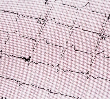 Ecocardiography report ECG showing irregular heartbeat